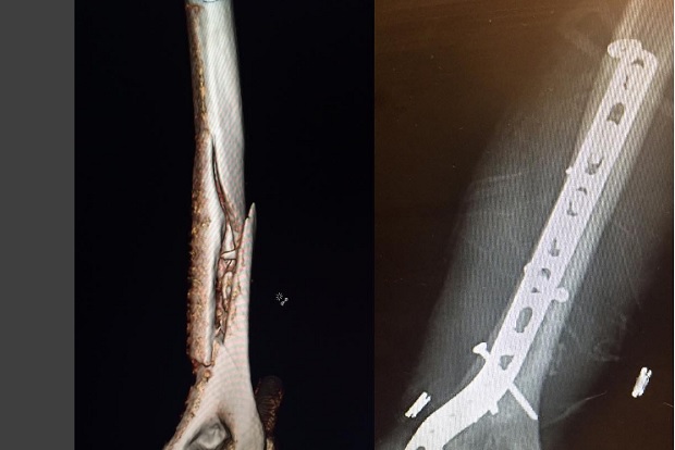 Lindsey Vonn mostraba a sus seguidores el estado del húmero de su brazo derecho Foto: @lindseyvonn